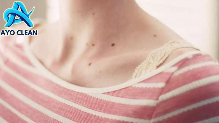 16 Cara Menghilangkan Tahi Lalat Hidup, Secara Alami dan Tindakan Medis ...