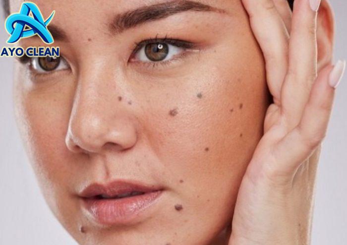 8 Cara Menghilangkan Tahi Lalat di Wajah dengan Cepat dan Mudah