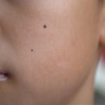 Seperti Apa yang Cara Aman untuk Menghilangkan Tahi Lalat?