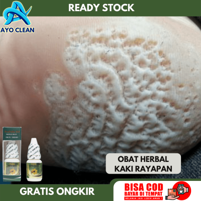 Obat Kaki Rayapan, Obat Telapak Kaki Rayapan, Obat Telapak Kaki ...