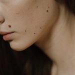 14 Cara Menghilangkan Tahi Lalat Mati dengan Aman dan Ampuh