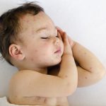 Cara menghilangkan bekas gigitan nyamuk pada bayi