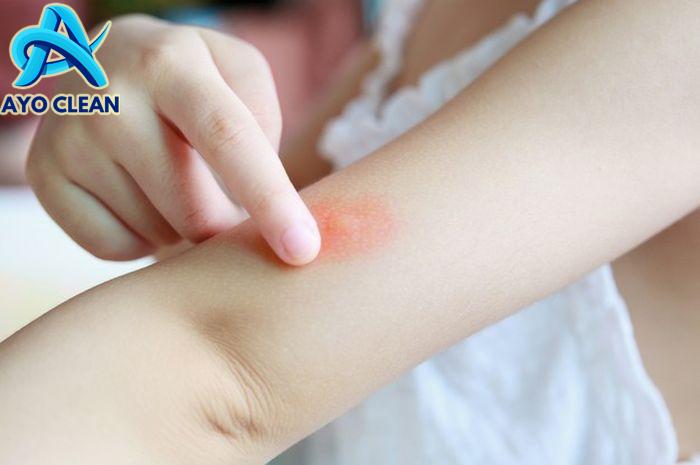 Pengalaman Menghilangkan Bekas Gigitan Nyamuk