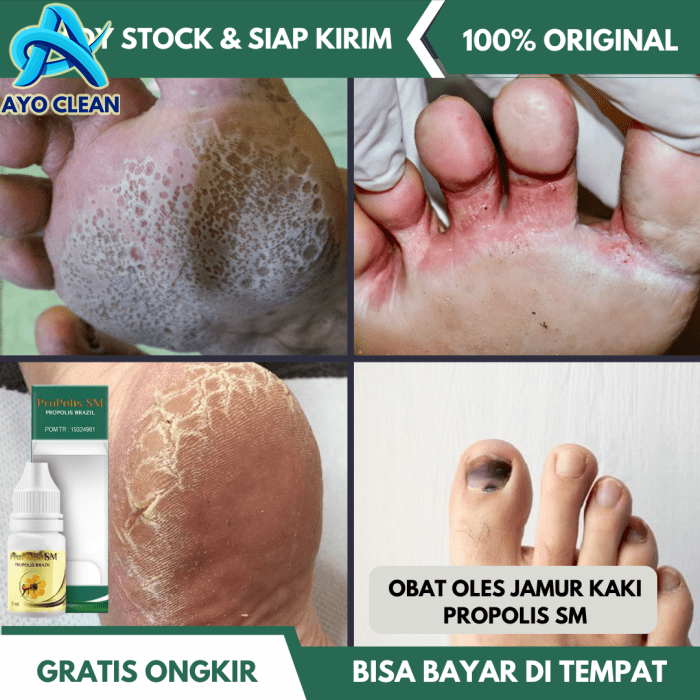 Obat Jamur Kaki, Infeksi Jamur pada Kulit Kaki, Tinea Pedis, Kuku ...