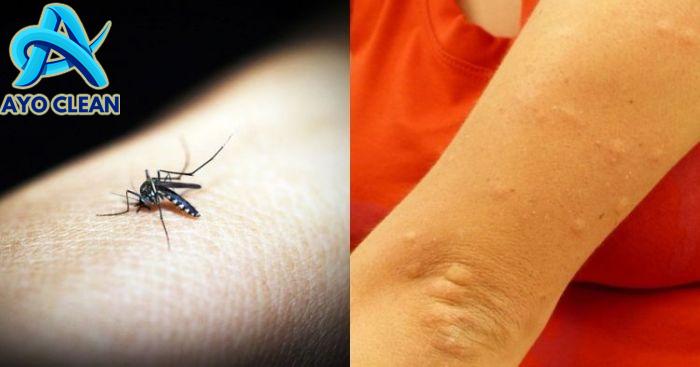 Cara menghilangkan gigitan nyamuk yang menghitam