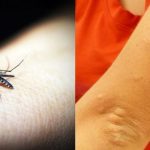 Cara menghilangkan bekas gigitan nyamuk di wajah