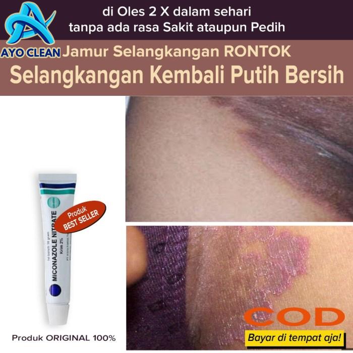 Jual Salep Obat Anti jamur gatal selangkangan Membersihkan jamur ...