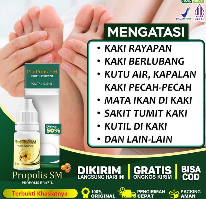 Cara Mengobati Kaki Rayapan Dengan Bawang Putih: Tips Dan Informasi ...