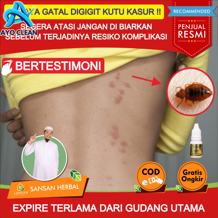 Cara Menghilangkan Bekas Gigitan Kutu Kasur - Menghilangkan Masalah