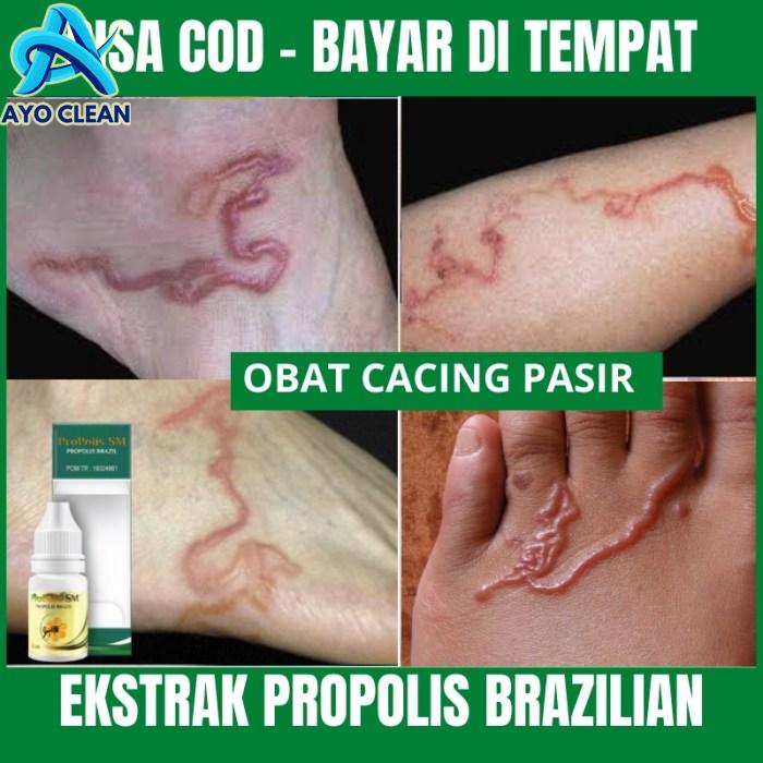 Cara menghilangkan cacing kecoa di dalam tubuh