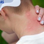 Tips dan Cara Menghilangkan Luka Bekas Gigitan Nyamuk, Kulit Kembali ...