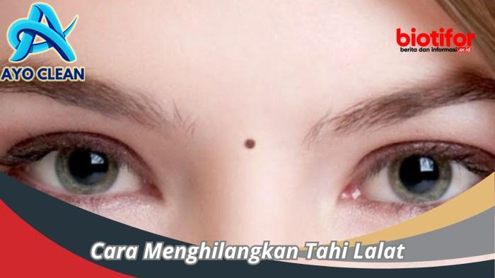 Cara menghilangkan tahi lalat dengan garam