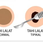 Cara Menghilangkan Tahi Lalat di Wajah dengan Alami dan Medis