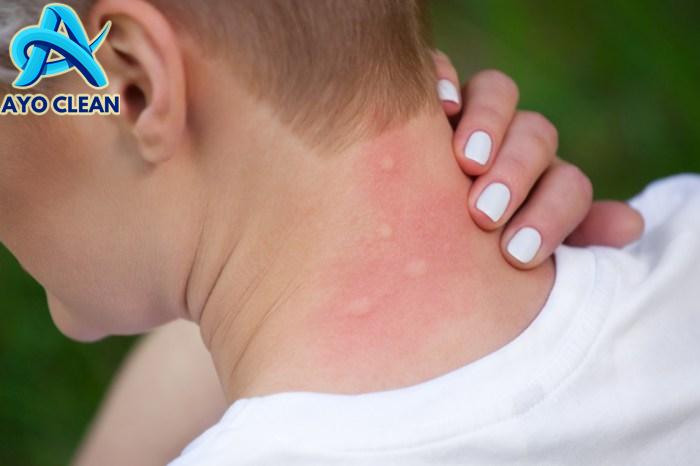 Cara Menghilangkan Bekas Gigitan Nyamuk yang Menghitam, Gunakan 5 Bahan ...