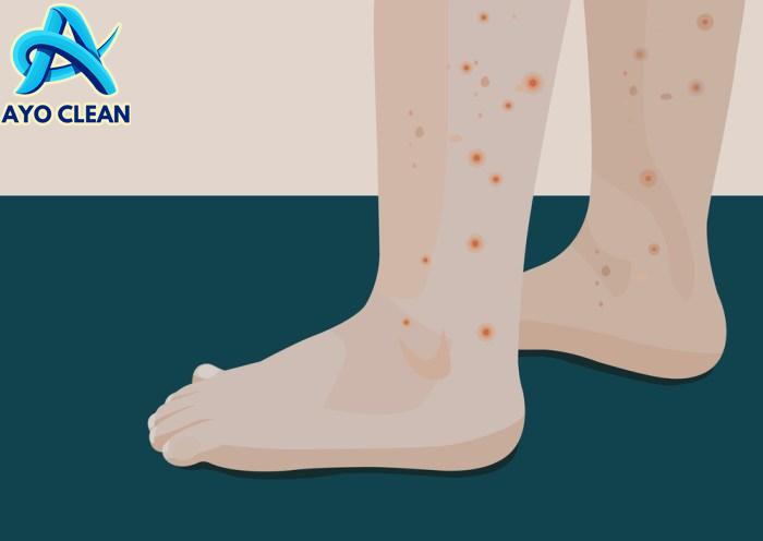 7 Cara Menghilangkan Bekas Gigitan Nyamuk yang Menghitam