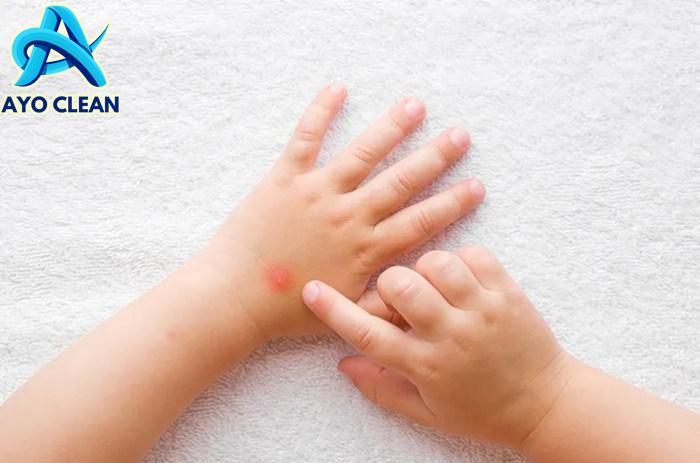 6 Cara Menghilangkan Bekas Gigitan Nyamuk pada Bayi