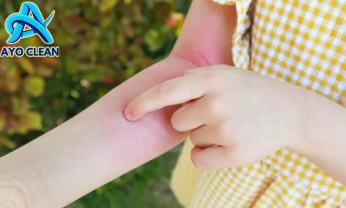 Safe Care Blog | Cara Mengatasi Gatal dan Bengkak Gigitan Serangga