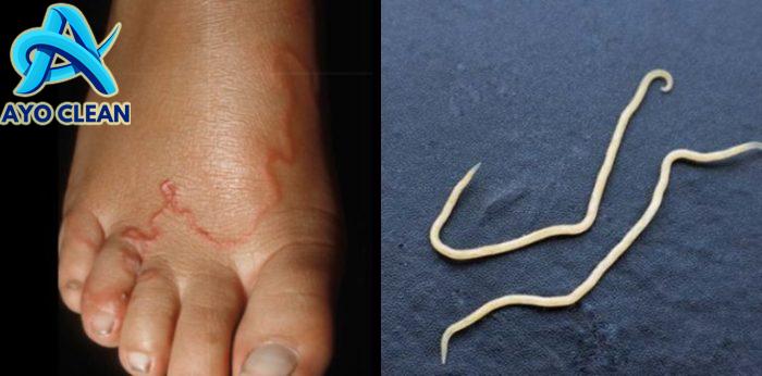 Hati-Hati, Ini Daftar Makanan Penyebab Cacing Kremi