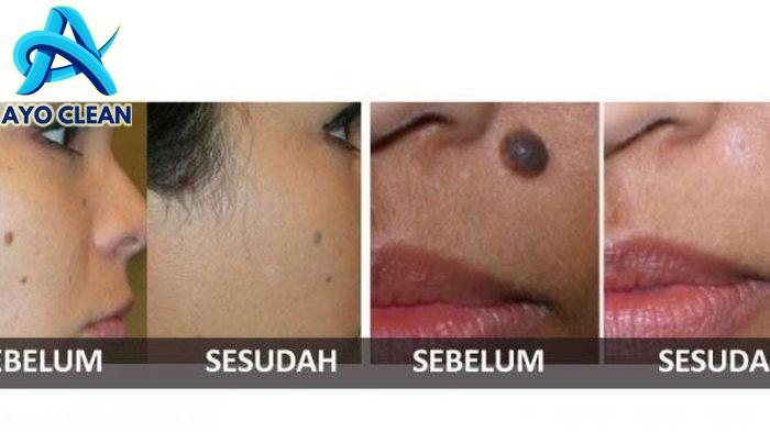 Cara mengecilkan tahi lalat dengan air liur