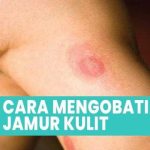5 Cara Mudah Mengatasi Jamur Kulit Hanya Menggunakan Bumbu-bumbu Dapur ...