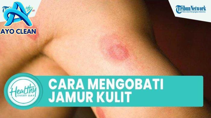 5 Cara Mudah Mengatasi Jamur Kulit Hanya Menggunakan Bumbu-bumbu Dapur ...