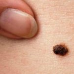 5 Cara Menghilangkan Tahi Lalat dengan Cepat