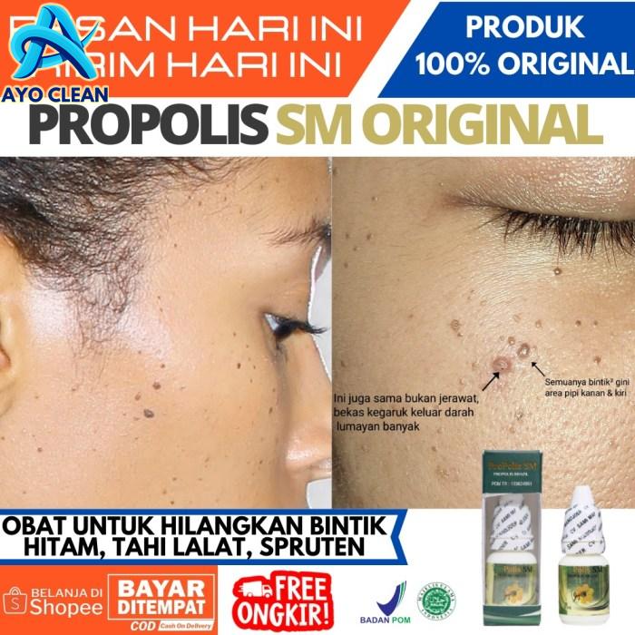 Jual Obat Menghilangkan Bintik Hitam di Wajah Seperti Tahi Lalat ...