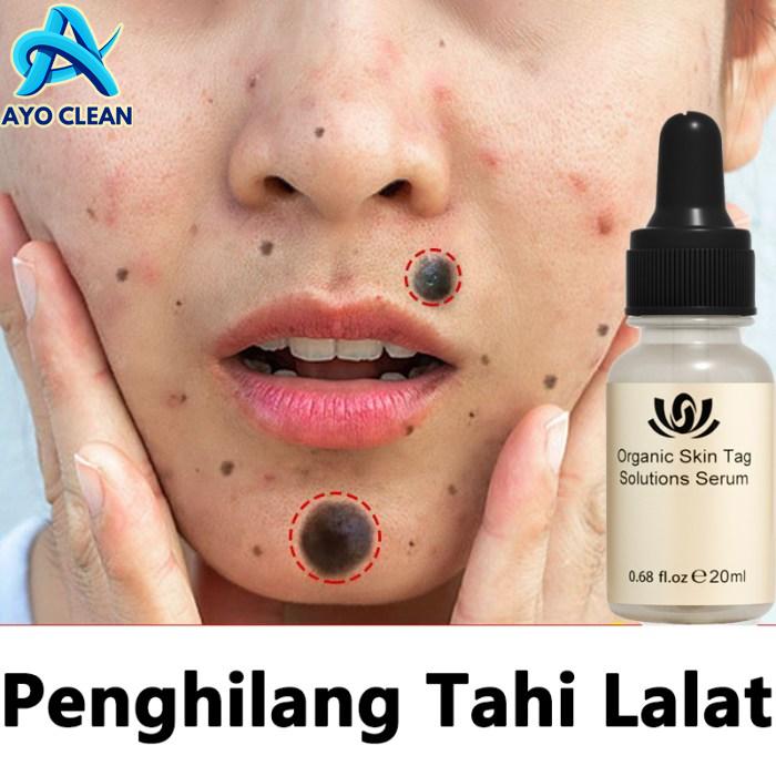 Cara menghilangkan tahi lalat secara alami tanpa bekas
