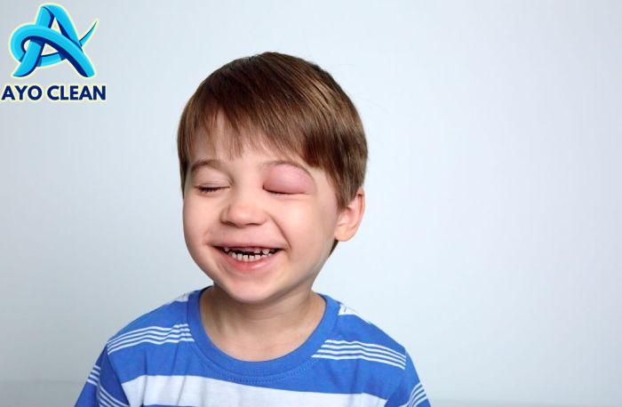 Cara mengobati bengkak digigit tikus