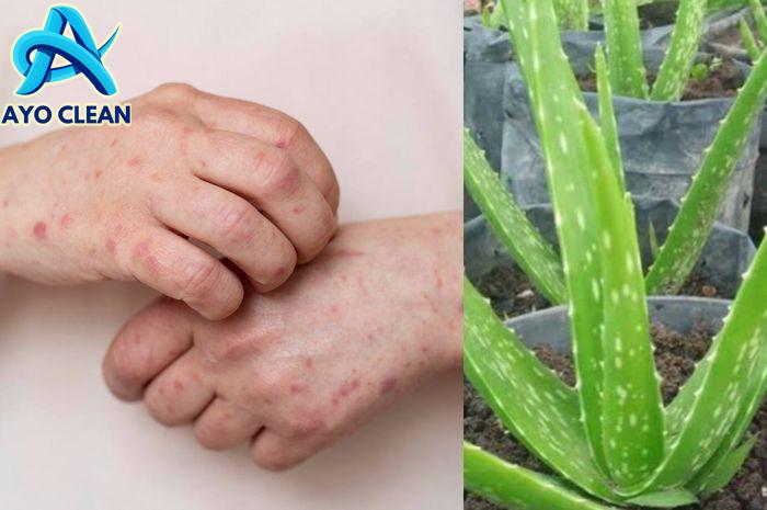 🔥 8 Cara Menghilangkan Bekas Gigitan Nyamuk Pada Bayi | Mengatasi Bekas ...