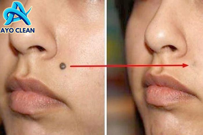 Cara Cepat Menghilangkan Tahi Lalat TANPA Operasi, Cukup Gunakan 1 ...